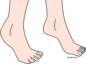 Opittu varpailla kävely idiopathic toe-walking